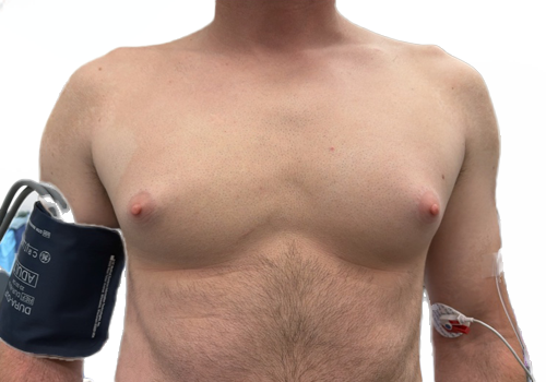 Male Breast Reduction