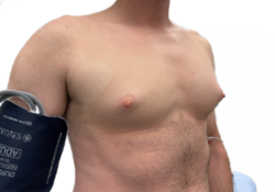 Male Breast Reduction