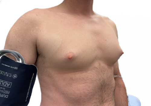 Male Breast Reduction