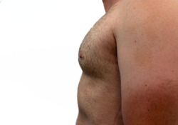 Male Breast Reduction