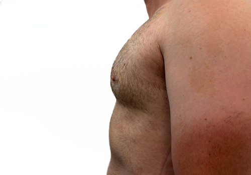 Male Breast Reduction