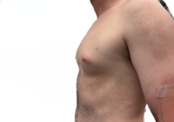 Male Breast Reduction