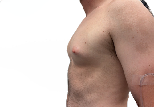 Male Breast Reduction