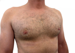 Male Breast Reduction