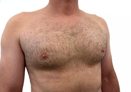 Male Breast Reduction