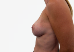 Breast Augmentation