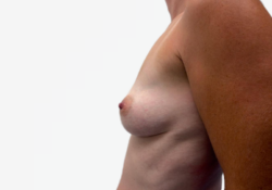 Breast Augmentation
