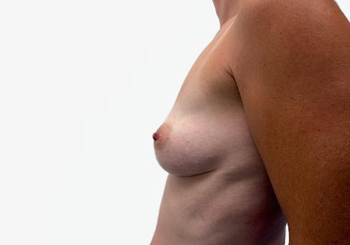 Breast Augmentation